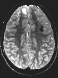 Focalis corticalis dysplasia Architecturalis-cytoarchitecturalis (Palmini Ib és IIa típus): megvastagodott cortex, elmosódott SZÁ-FÁ határ, enyhe T2-FLAIR jelfokozódás, gyakran