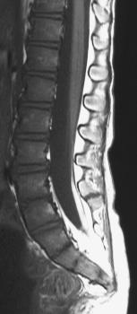 B/A. Zárt dysraphismusok subcutan masszával: Lipomyelocele A gerinc fejlődési rendellenességek klinikaineuroradiológiai osztályozása (P. Tortori-Donati) B. /B.