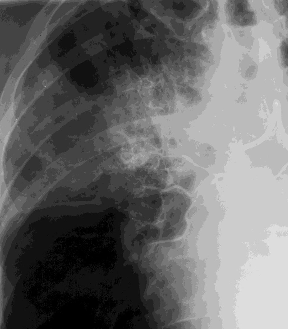 Szelektív cytostatikus kezelés inoperabilis