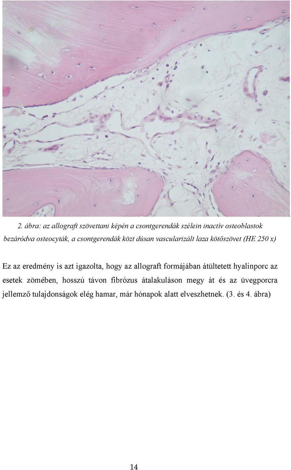 az allograft formájában átültetett hyalinporc az esetek zömében, hosszú távon fibrózus átalakuláson megy