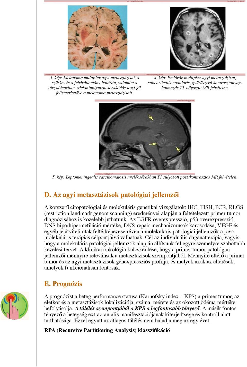 kép: Leptomeningealis carcinomatosis nyelőcsőrákban T1 súlyozott posztkontrasztos MR felvételen. D.