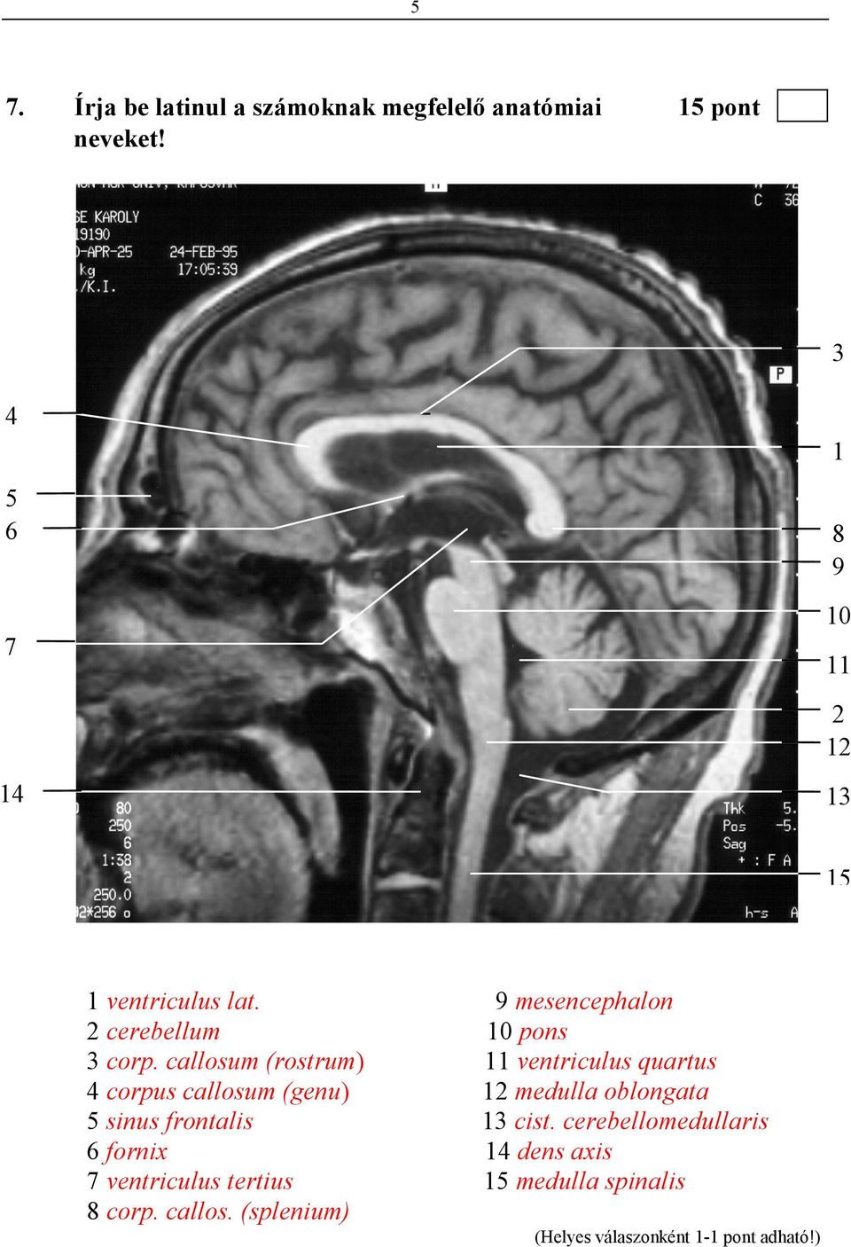 callosum (rostrum) 4 corpus callosum (genu) 5 sinus frontalis 6 fornix 7 ventriculus tertius 8