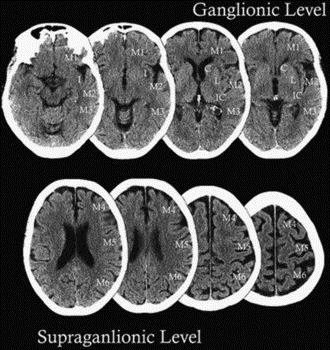 Az akut ischaemia korai finom CT jelei Az akut ischaemia korai finom CT jelei 1. Szürkeállomány denzitás csökkenése a. Törzsdúcok elmosódása b.