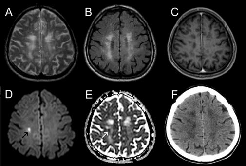 Kollaterális keringés Kis CBV/nagyobb CBF, mismatch Jó jelölt a thrombolysis kezelésre Neg. CT, kis CBV, nagy CBF és MTT, jobb ACM occlusio. Terápia után csak kis infarctus marad.