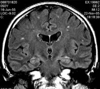 Cerebralis amyloid angiopathia Moyamoya Bal oldalon GRE T2*, jobb oldalon TSE T2 súlyozott képek: A bal oldali képeken látható jelmentes lerakódások a jobb oldali képeken nem ábrázolódnak.