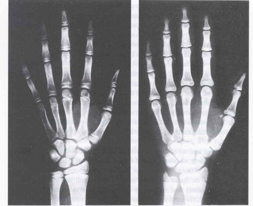 14 éves fiúk kézfeje röntgenképen 12