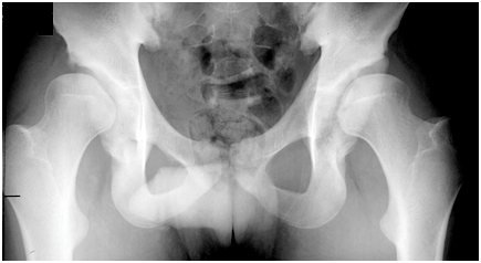 Radiológiai módszerek Röntgen Csípőízület morfológia és csípőízületi porc vastagság angol ikerregiszter - 222 MZ és 240 DZ ikerpár az acetabulum dysplasia a csípőízület osteoarthritise, mely nőkben