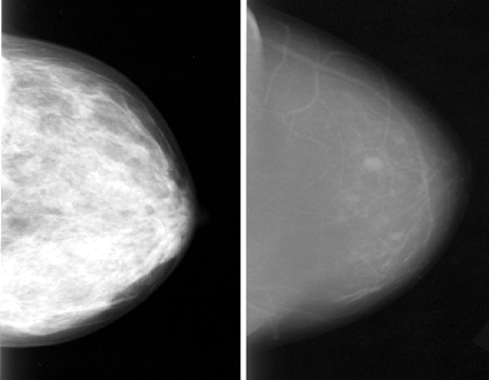 Radiológiai módszerek Mammográfia Mammográfia denzitás örökletessége: az emlőrák rizikófaktora? denz emlőállomány esetén az emlőrák 1.