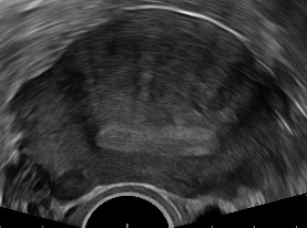 Radiológiai módszerek Ultrahang Uterus myomák örökletessége és rizikó faktorai finn ikervizsgálat - 80 MZ és 80 DZ ikerpár transvaginalis ultrahang vizsgálata myoma előfordulása 66%-os myomás nőknek