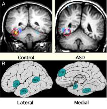Funkcionális eltérések autizmus-spektrum zavarokban Arcfelismerés, érzelemfelismerés Közös figyelmi fókusz Mentalizáció Imitáció, tükörsejtrendszer eltérései IFG inferior frontalis gyrus