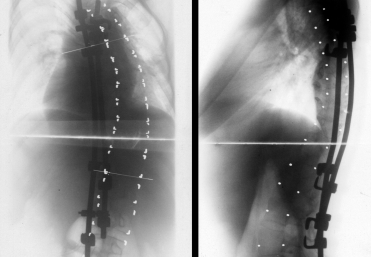 3. ábra a-b. A csontos fúzió nélküli disztrakciós mûtét utáni állapot PA és oldalnézetben 4. ábra. A végeredmény: CD-szerinti korrekciós spondylodézis utáni állapot PA és oldalnézetben (a Th VII-Th XII.