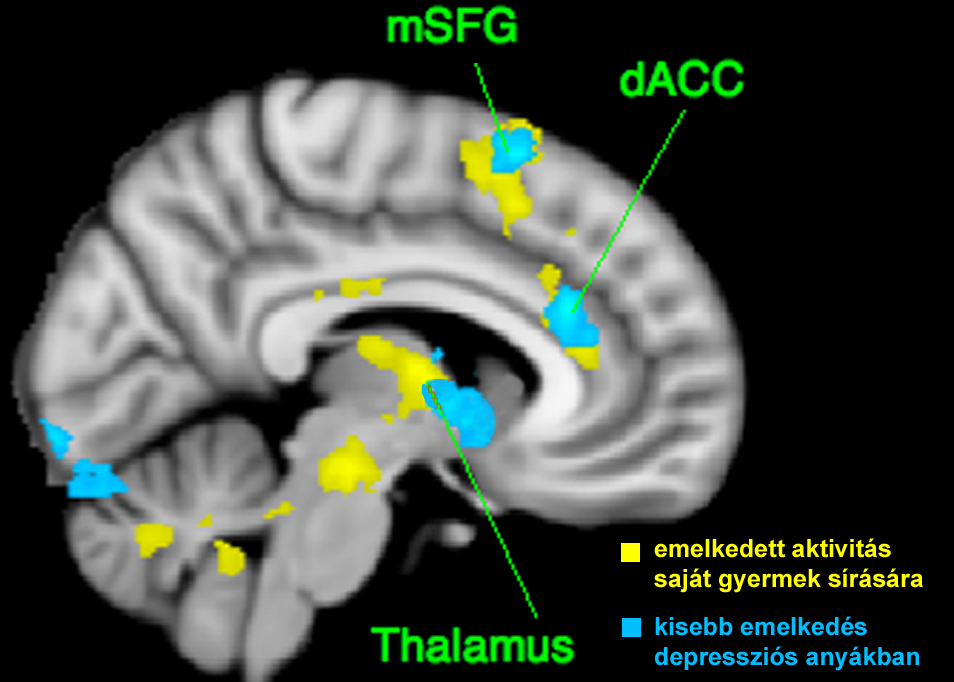 Postpartum depresszióban érintett agyterületek (Pl. az anterior cinguláris cortex - ACC) Heidemarie K. Laurent, Jennifer C.