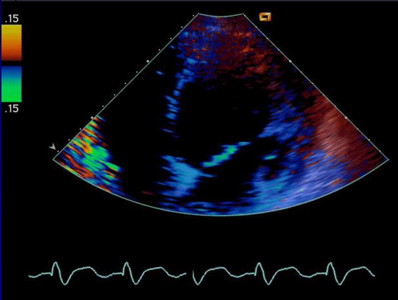3. MIOKARDIÁLIS DOPPLER-ECHOCARDIOGRAPHIA A miokardiális Doppler-technikával a falmozgások irányát és sebességét tudjuk vizualizálni színek segítségével.