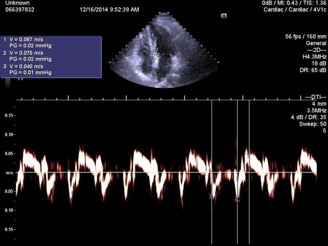 A szegmensek mozgási sebességének pontos mérésére a szöveti Doppler (TDI: tissue Doppler Imaging) pulzatilis Dopplert módját használjuk.