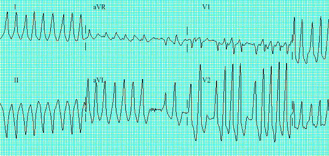 Tachyarrhythmia Stabil beteg -