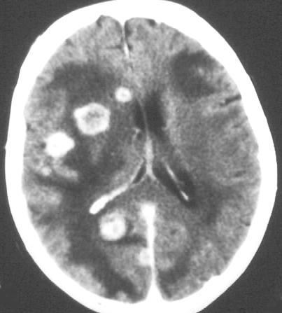 TUMOROK Multiplicitás Metastasis