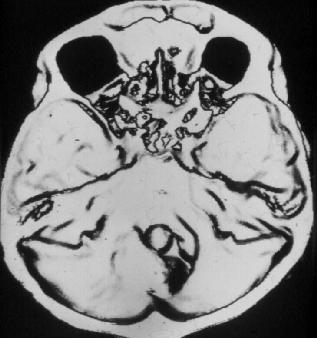 Primer tumorok Meningeoma 25% parasagittalis 20% convexitas, 05-20% sphenoid.