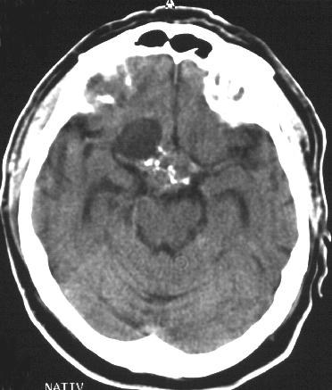 Primer tumorok Craniopharyngeoma a Rathke-tasak maradványa prim.