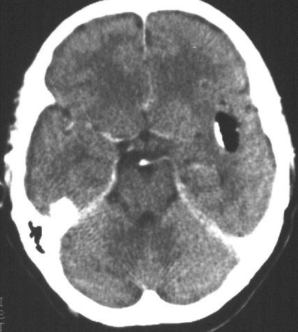 Primer tumorok Lipoma,dermoid