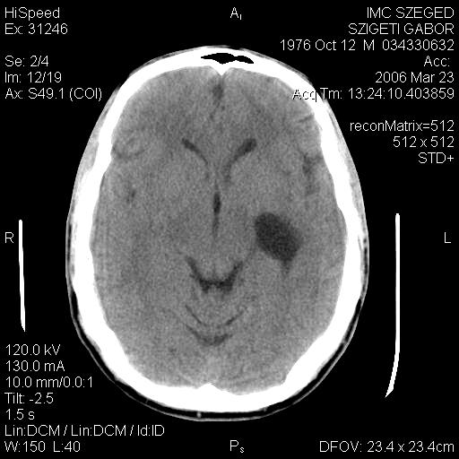 Primer tumorok Epidermoid Liquorterekben növekszik Folyadék denzitású,