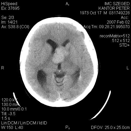 Primer tumorok Ependymoma - plasztikus IV. kamrai tumor - összes agytumor 2-8 %-a, 60% infratent (90% IV.