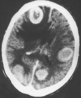 METASTASISOK Metastasis Tüdő, emlő, melanoma, gyomor-bél, urogenitalis