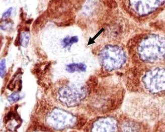 18.ábra ps6 immunhisztokémia synoviális sarcoma (bal) és emlőcarcinoma mintában (jobb).