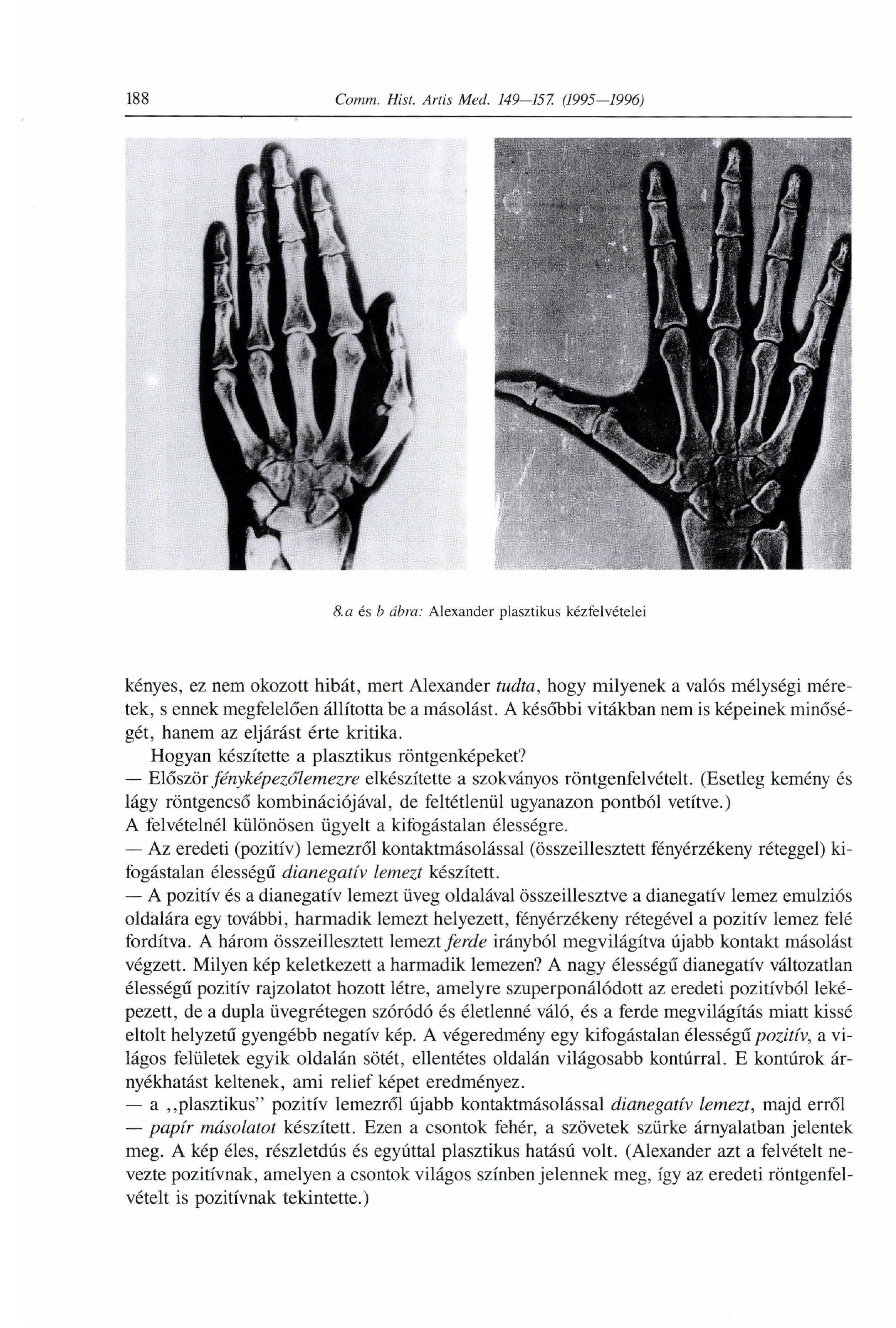 8.a és b ábra: Alexander plasztikus kéztelvételei kényes, ez nem okozott hibát, mert Alexander tudta, hogy milyenek a valós mélységi mére tek, s ennek megfelelően állította be a másolást.