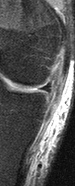 LCM ruptura lokalizációi proximalis