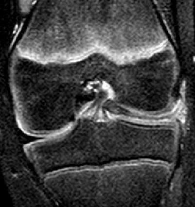 congenitalis anomalia:discoid meniscus JOBB BAL