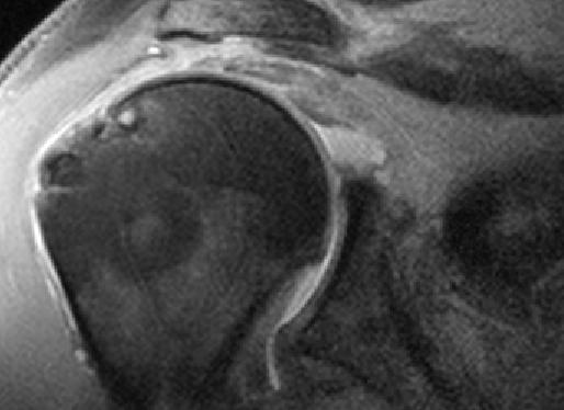 A váll impingement szindrómája: kínos szorulás Impingement: ütközés, akadás csontos kompresszió: a humerus fej és az acromion között Shoulder imping.