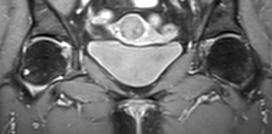Subcorticalis synovialis cysta Pitt,s pit, herniation pit általában véletlen lelet a röntgenfelvételen