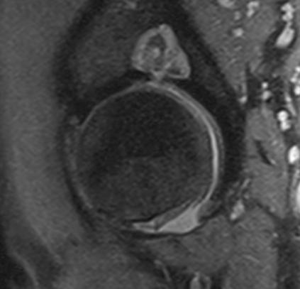 Coxarthrosis MR jelei STIR PD FS ízűleti rés szűkület chondralis léziók labrum