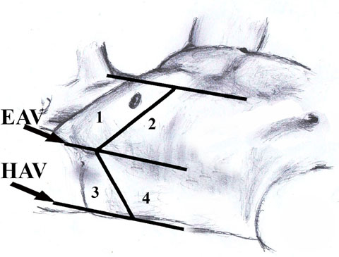4. ábra. Mellkas: pleuralis folyadék és ptx vizsgálata, sémás ábrán. 1. JFN (jobb felső negyed), 2. BFN (bal felső negyed), 3. jobb pleuralis metszet, 4. bal pleuralis metszet, 5.