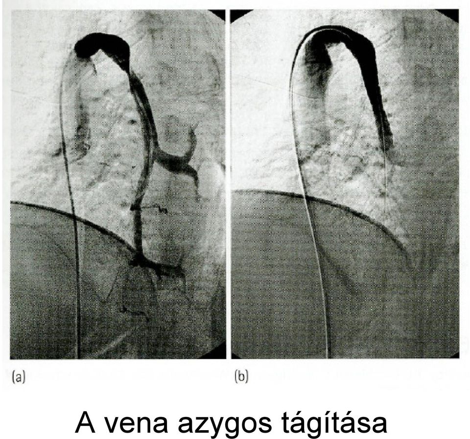 tágítása
