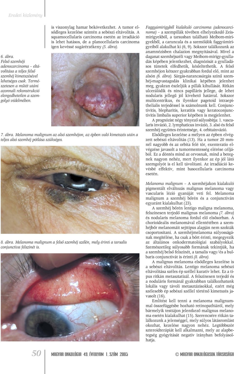 A squamocellularis carcinoma esetén az irradiáció is lehet hatásos, de a planocellularis carcinoma igen kevéssé sugárérzékeny (5. ábra)
