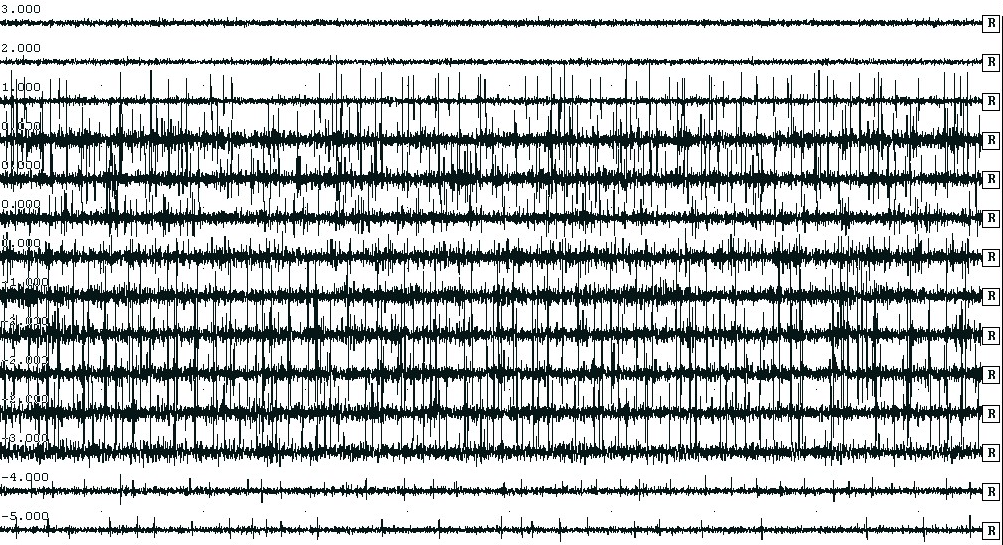 36 2. ábra. Mikroelektródás regisztráció pallidális elektróda beültetése során egy primer generalizált disztóniás betegnél propofol szedáció mellett.