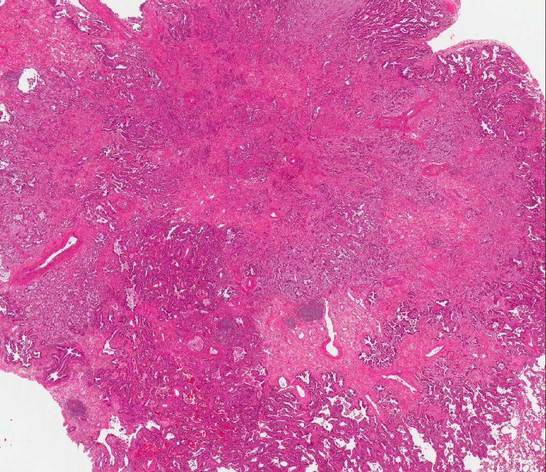 Minimálisan invaziv adenocarcinoma (MIA) nem mucinózus és/vagy mucinózus