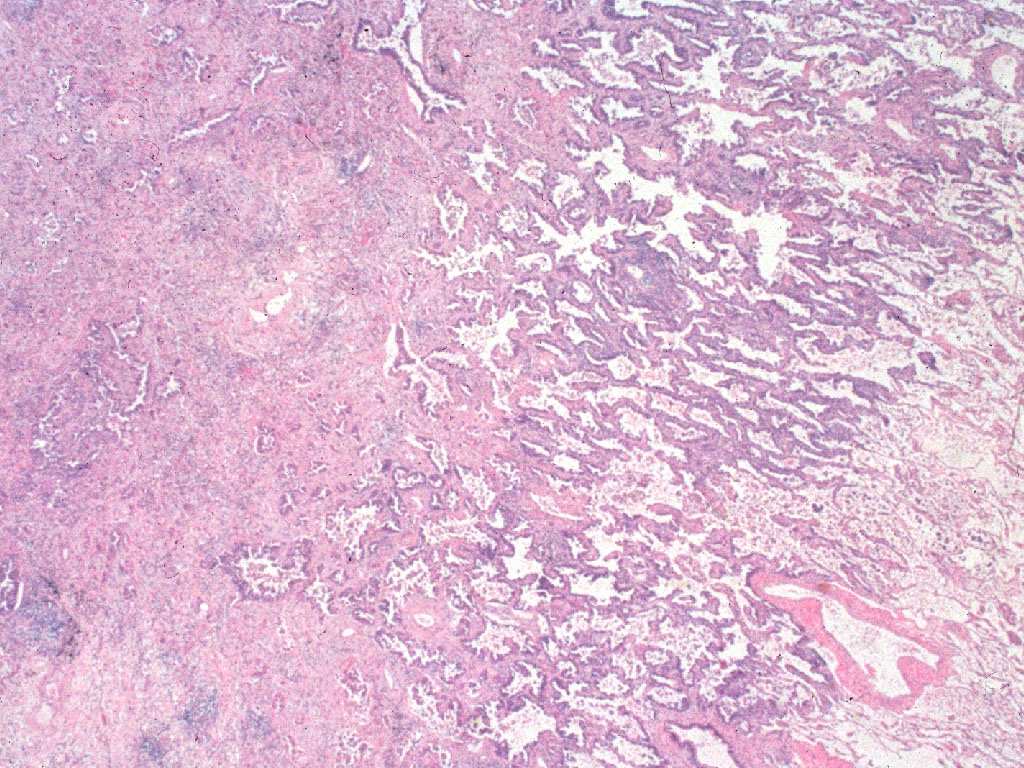 Invaziv adenocarcinoma