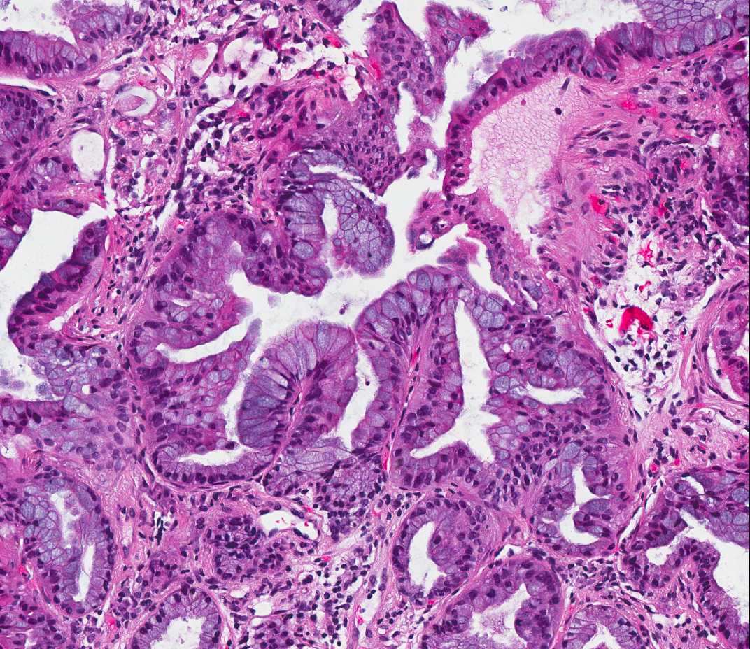 Invaziv mucinózus adenocarcinoma Korábban: Mucinózus bronchioloalveoláris carcinoma Kritériumok (egy is elég) > 3