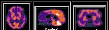 33 Gyakori perfúzió-rendellenességek Hiányzik infarktus trauma sebészi beavatkozás Csökkent ischemia dementia depresszió epilepszia nyugalomban Megnövekedett luxus perfúzió epilepszia roham közben