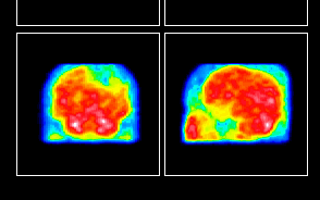 Normális agyi vérátáramlás Normális radiofarmakon-felvétel Szimmetrikus eloszlás Nagyobb radioaktivitás: szürke állomány, basalis ganglionok, occipitalis cortex, cerebellum Alacsonyabb