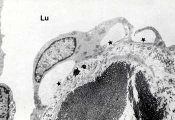 3 3. ábra. A dermális nyirokkapilláris endothel sejtjei elemelkednek a kötıszöveti alapról, és benyomulnak a lumenbe (Lu).