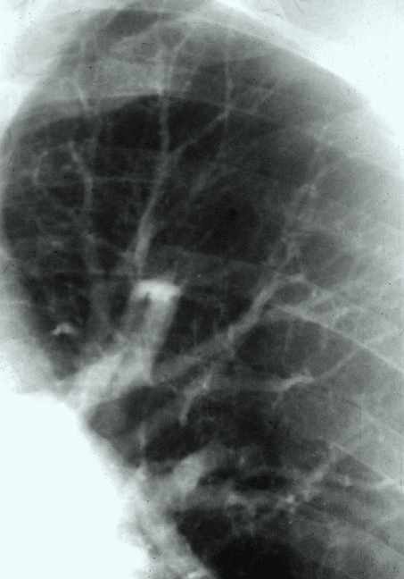 Vérátáramlás pulmonalis