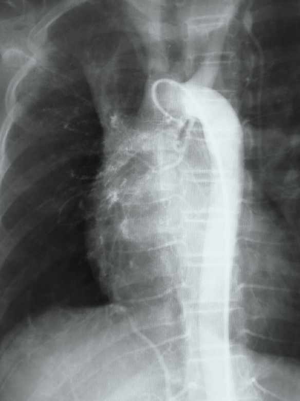 Tüdővérzés daganatos vagy tbc-s érfal kimaródás