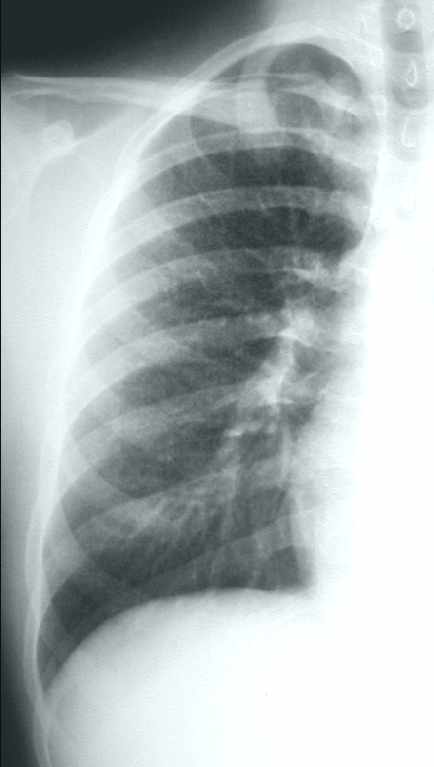 pulmonalis hypertensio