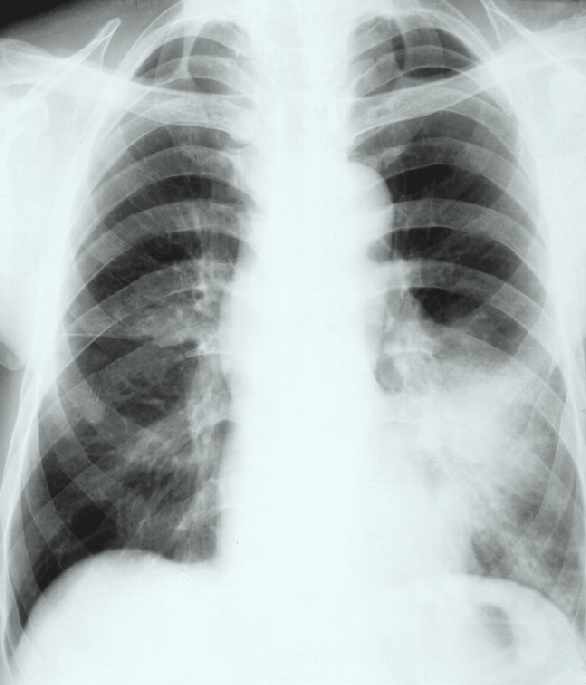 Lobaris pneumonia újabban foltos megjelenésű, de tiszteli a lebenyhatárt több
