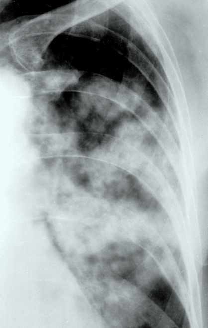 Bronchopneumonia gyakori, képe gyorsan változik, hilusi