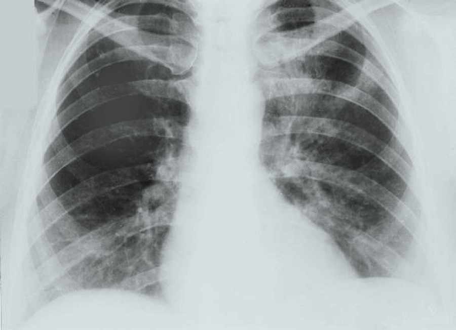 Interstitialis pneumonia állatról emberre terjedhet (ornithosis, madárinfluenza) gyakran