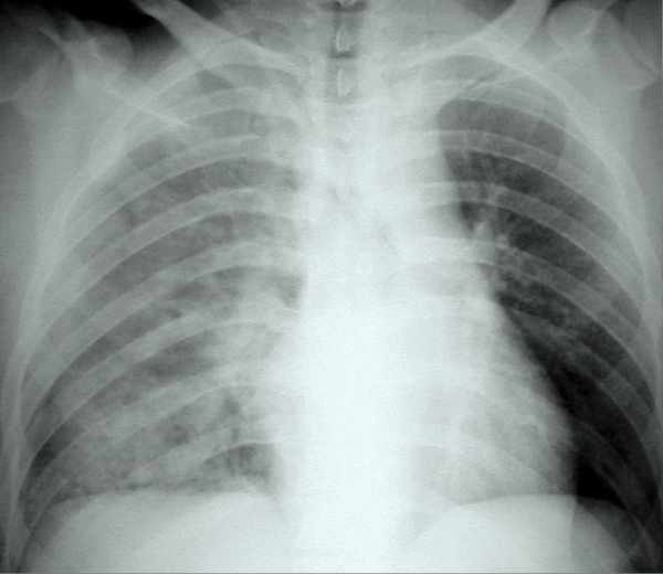 Interstitialis pneumonia gyakran járványszerűen terjed
